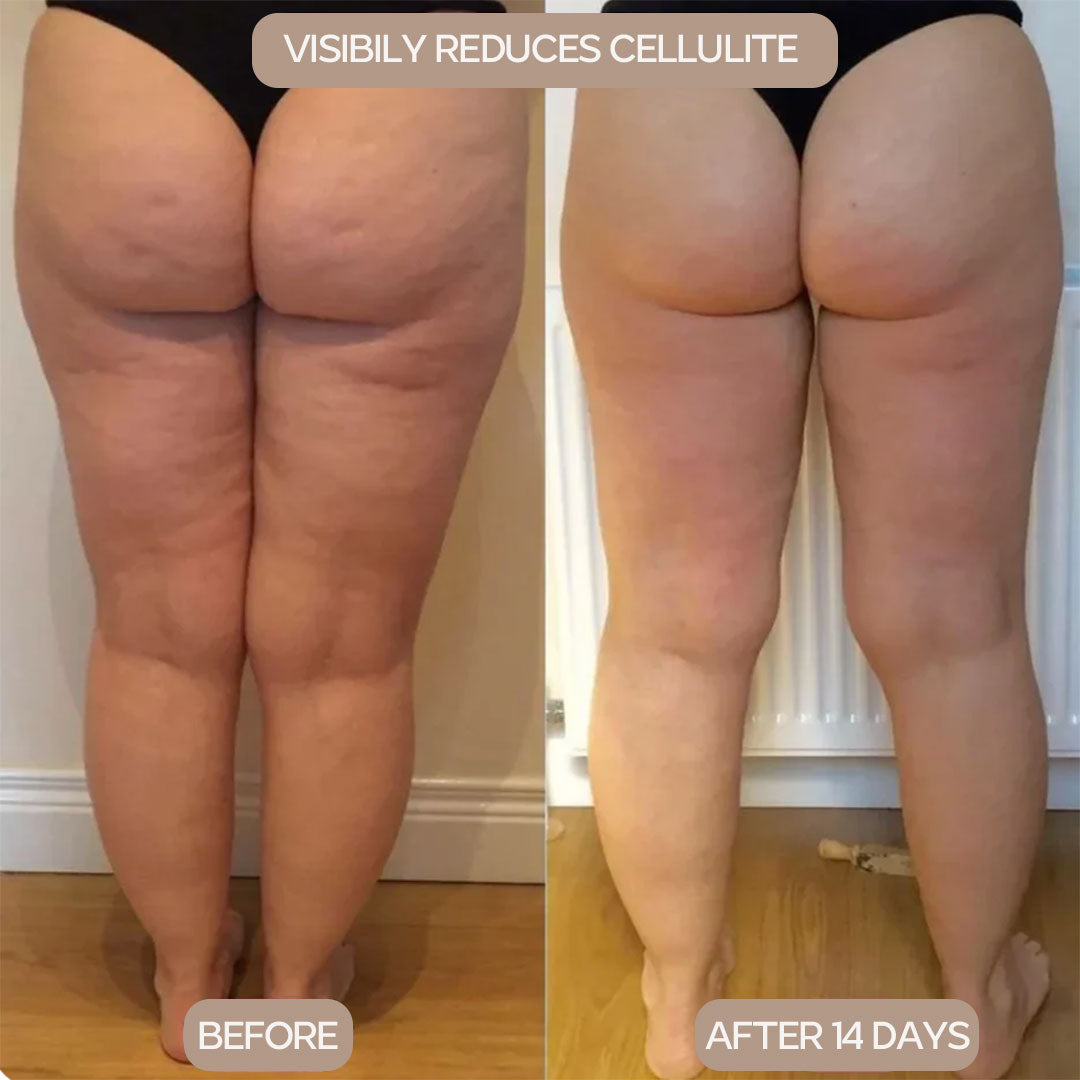 Anti-Cellulite Fascia Massager
